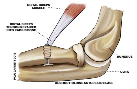 Aoa Presentation On Distal Biceps Tendon Repairs Dr Paul Jarrett