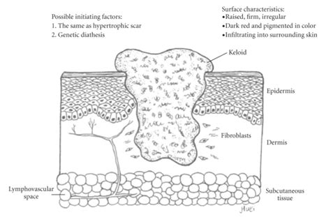 The Keloid Healing Result Several Surface Characteristics Of Keloid