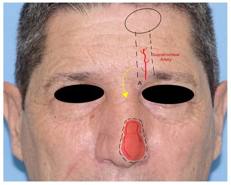 JCM Free Full Text Locoregional Flaps For The Reconstruction Of