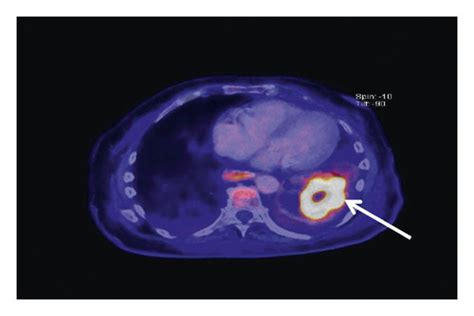 A Petct Scan Showing Slightly Increased 18f Fdg Uptake Of The Spleen