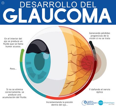 ¿por Qué Es Importante Detectar El Glaucoma Top Doctors