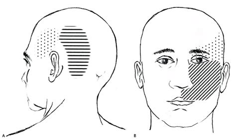 Diagrams Demonstrating The Distribution Of Occipital Neuralgia And