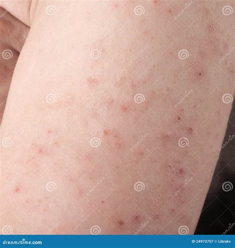 Allergic Rash Dermatitis Skin Stock Image 53329993
