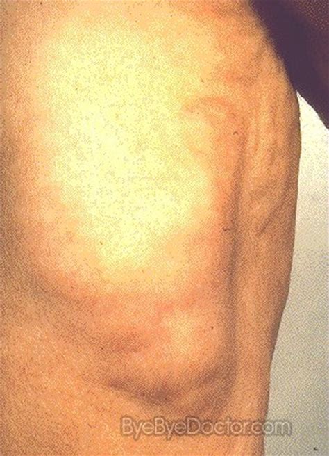 Lipoma Pictures Symptoms Causes Removal Treatment