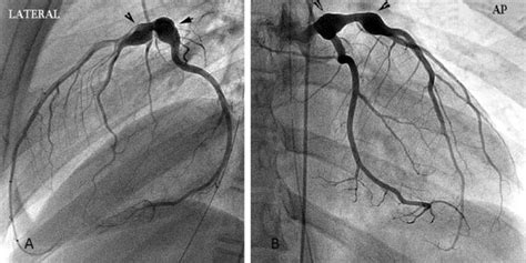 A And B Aneurysms Revealed By Angiography Lateral And Ap Views Of