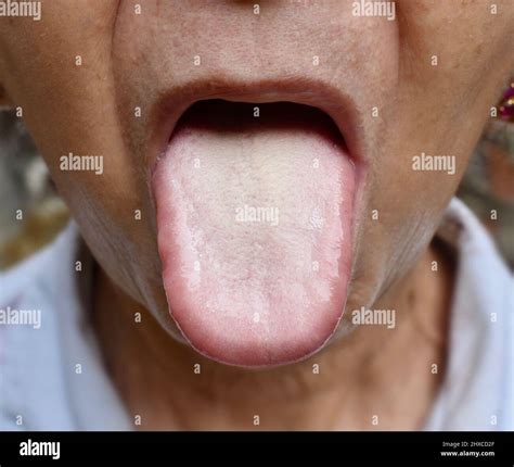 Beschichtete Zunge Oder Weiße Zunge Einer Asiatischen Chinesischen