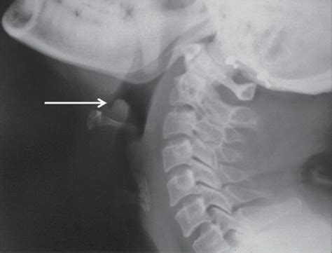 Lateral Soft Tissue Radiograph Of The Neck Showing “t Open I