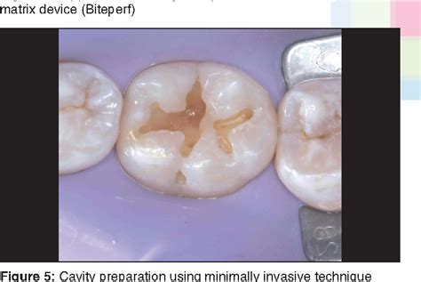 Pdf Restoration Of Posterior Teeth Using Occlusal Matrix Technique
