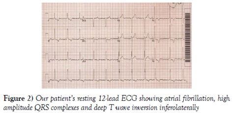 A Clinically And Echocardiographically Demonstrable Dynamic Left