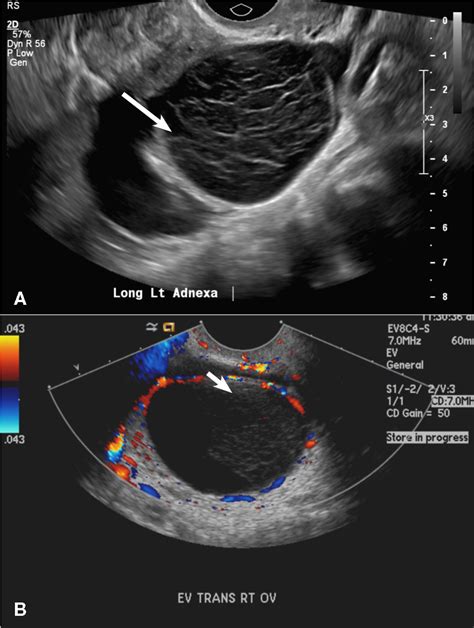 How Bleeding Ovarian Cysts Look On Transvaginal Ultrasound My XXX Hot