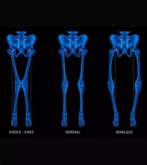 Rickets In Children Signs Symptoms Causes And Treatment