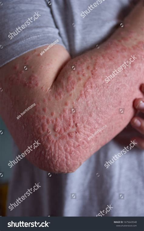 Forearm View Woman Psoriasis Stock Photo 1675643548 Shutterstock