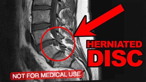 L4 L5 Micro Discectomy 1 Year After My Herniated Disc Surgery Youtube