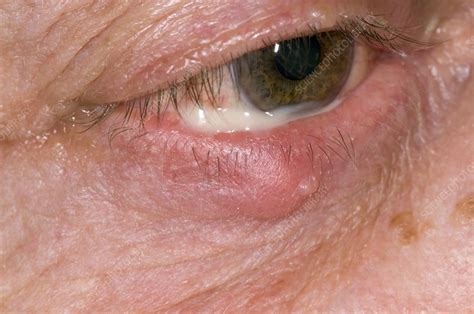 Stye On The Lower Eyelid Stock Image C0085726 Science Photo Library