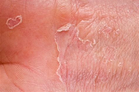 Pictures Of Eczema Contact Dermatitis Pictures