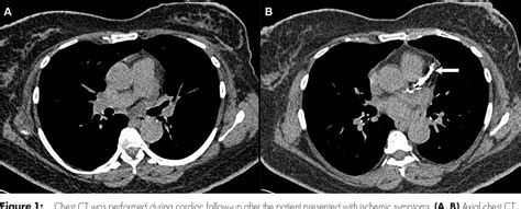Figure 1 From Recurrent Metastatic Breast Cancer In Internal Mammary