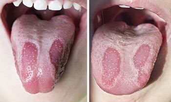 This balds as well as the problem becomes evident by the white locations about the mouth, regional mouth affects the surface of the tongue by producing it seems as. Geographic Tongue - Causes & Treatments