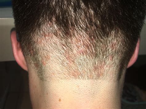 Skin Concerns Between Haircuts The Back Of My Head Gets These Red