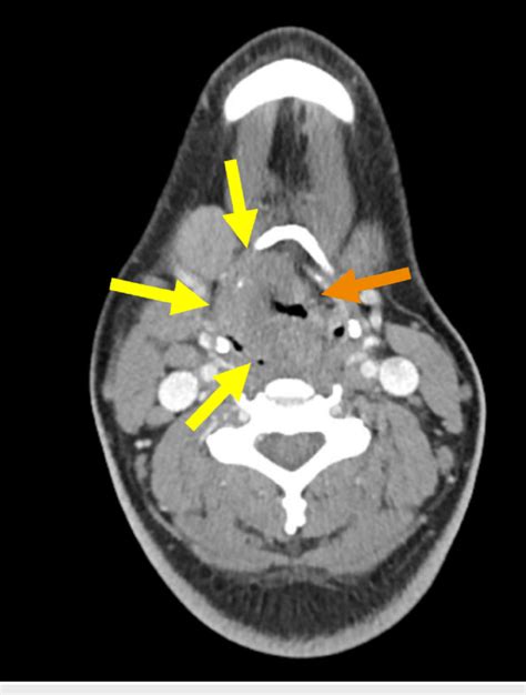Axial Contrast Enhanced Computed Tomography Ct Image Of The Neck