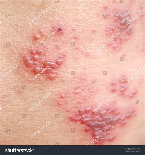 Raised Red Bumps Blisters Caused By Stockfoto 297165575 Shutterstock