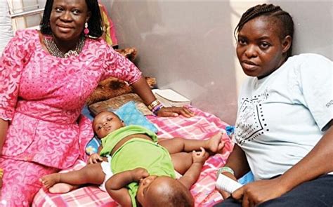 Photos Nigerian Conjoined Twins Miracle And Testimony Ayeni’s Surgery Sponsored By Arik Air