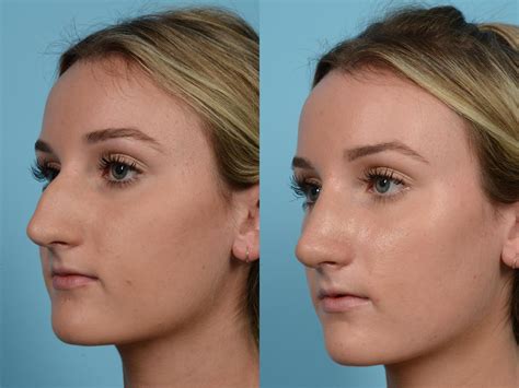 Rhinoplasty By Dr Mustoe Before And After Pictures Case Chicago IL TLKM Plastic Surgery