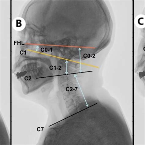 Illustrative Explanation Of Sagittal Cervical Parameters Download