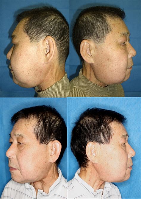 Lymphaticovenous Anastomosis For Facial Lymphoedema After Multiple