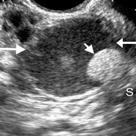 PDF Evaluation Of The Pattern Of Sonographic Detectable Adnexal
