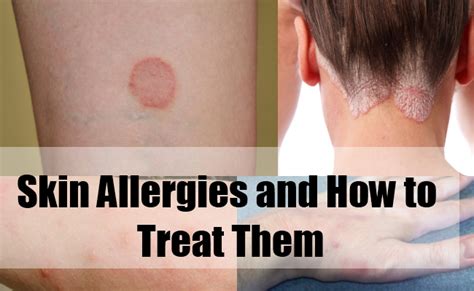 Skin Allergies And How To Treat Them Natural Home Remedies And Supplements