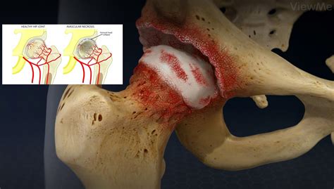 Early Detection Of Bone Death Avascular Necrosis Can Reverse The