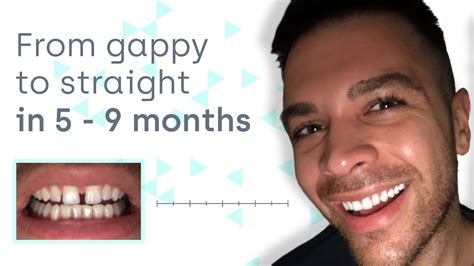 How To Close Teeth Gaps Safely And Invisibly At Home Youtube
