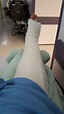 The day I broke my leg - broken tibia and fibula with intramedullary nail