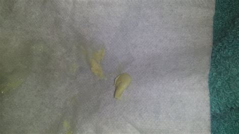Green vaginal discharge is an abnormal type of discharge and can be the first sign of an infection that will require serious treatment. Image 15 of Light Green Discharge During Pregnancy No Odor ...