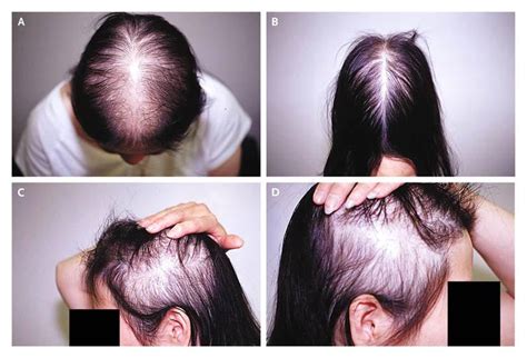 Alopecia Universalis Women