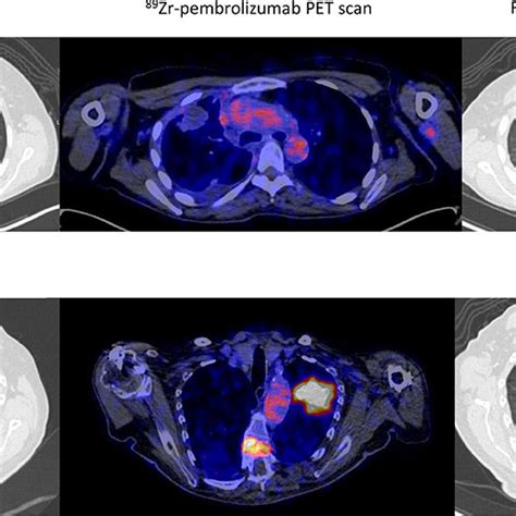 Two Examples Of 89 Zr Zr Pembrolizumab Tumor Uptake Scaled 0 8 In