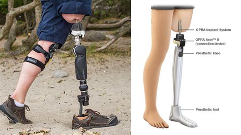 Fda Approves Implant For Adults With Above The Knee Amputations