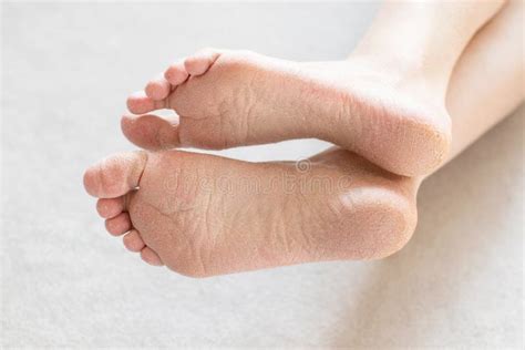 Close Up Cracked Heels Health Problems With Skin On Feet Stock Photo