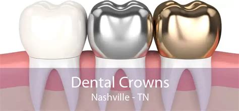 Affordable Dental Crowns Nashville Tn Dental Crowns Near Me