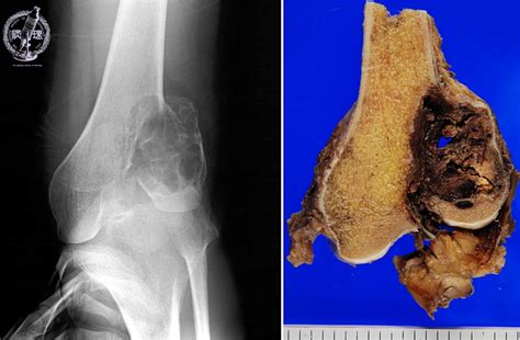 19bone Joint 9 Giant Cell Tumor Of The Bonepathology Core Pictures