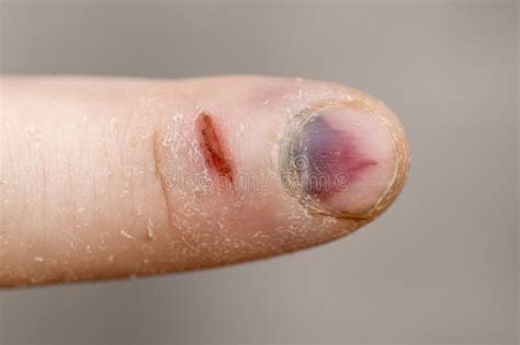 Finger With Bruised Nail Subungual Hematoma Stock Image Image Of