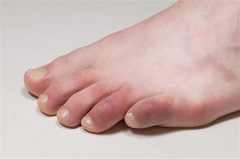 Did You Get Covid Toes Research Shows New Side Effect Of Virus Herie