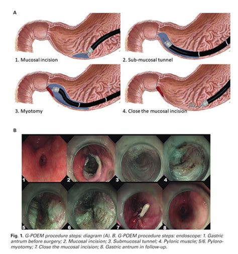 Gastric Per Oral Endoscopic Myotomy G Poem Is A Promising Treatment