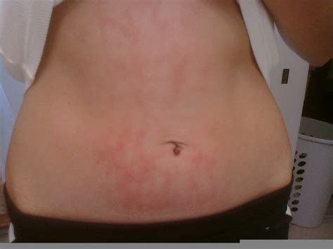 Heat Rash Stomach Free Images At Vector Clip Art Online