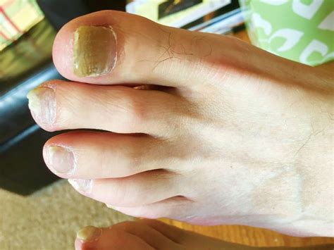 Can Toenail Fungus Spread To Other Parts Of The Body Destroy Nail Fungus
