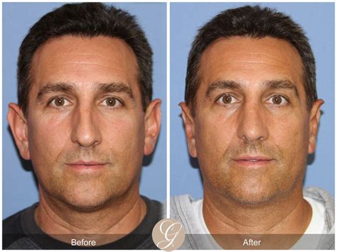 Male Rhinoplasty Before And After Photos From Dr Kevin Sadati