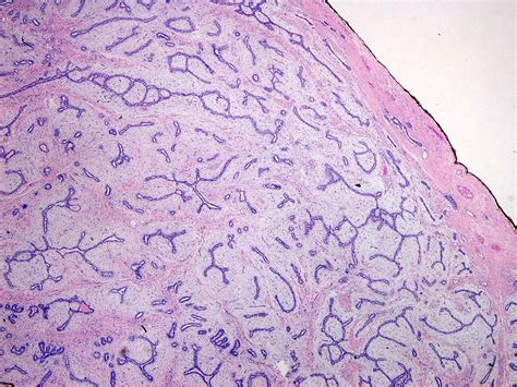 Pathology Outlines Fibroadenoma