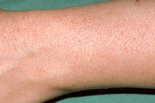 Although keratosis pilaris is usually harmless, it can leave your skin feeling itchy, rough and dry. Keratosis pilaris - NHS