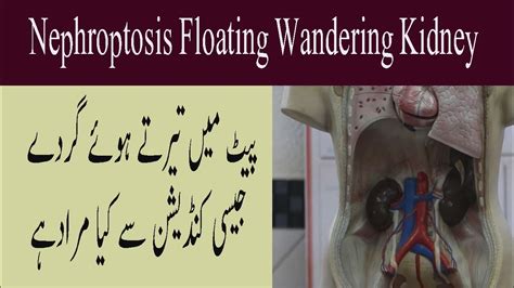 What Is Nephroptosis Floating Wandering Kidney In Urdu Pait Ma Tarne