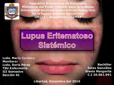 Lupus Eritematoso Sistematico